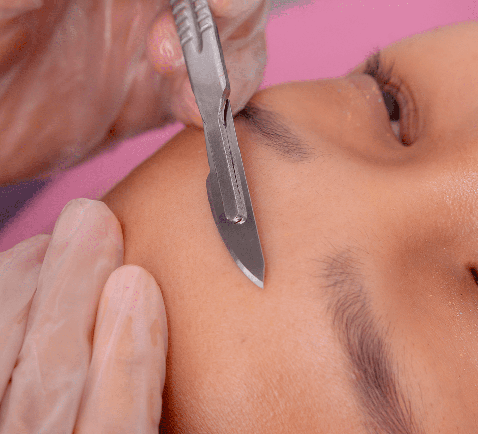 Dermaplaning procedure on woman's face