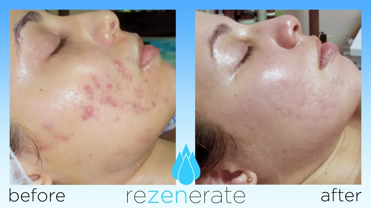 Acne improvement with skincare treatment