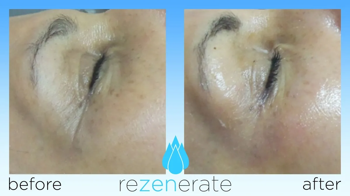 Skin improvement with Rezenerate