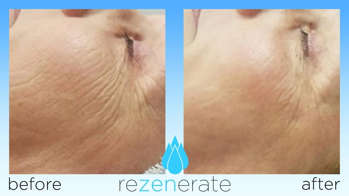 Wrinkle reduction before and after