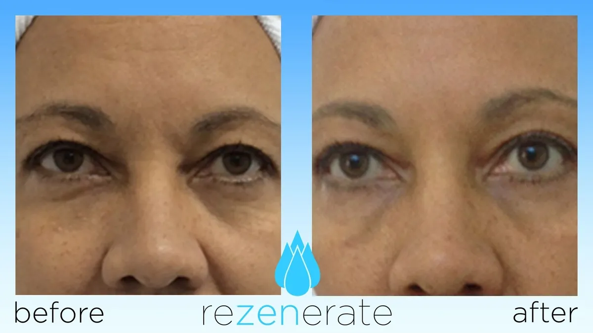 Facial skin improvement before and after