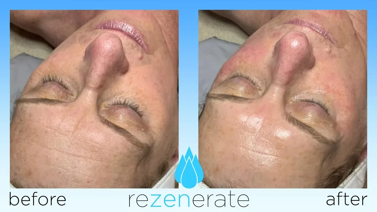 Improved skin texture after treatment